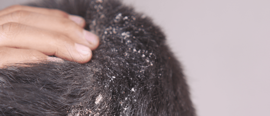 Hombre con caspa en el cabello
